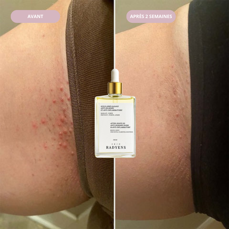 Huile Anti-Incarnés (100ml)