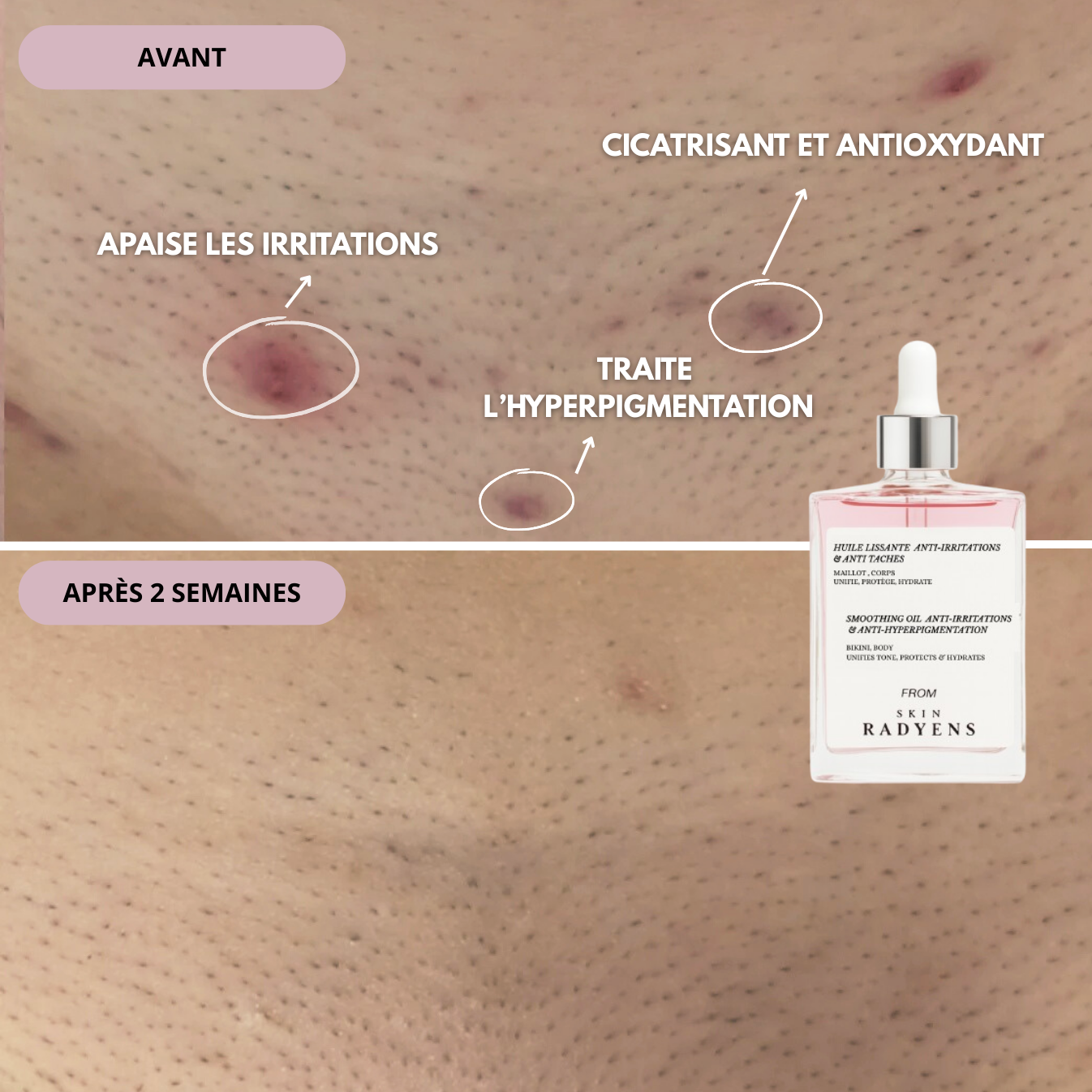 Huile Anti-Hyperpigmentation Post-rasage
