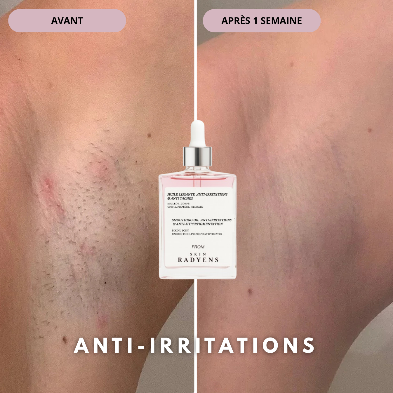 Huile Anti-Hyperpigmentation Post-rasage