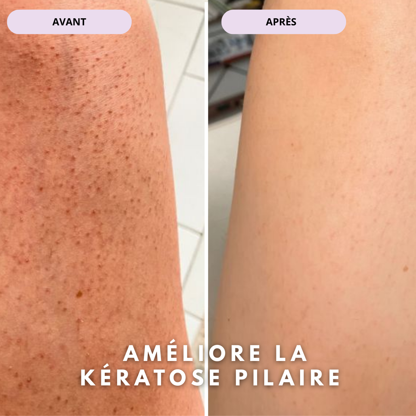 Huile Anti-Hyperpigmentation Post-rasage
